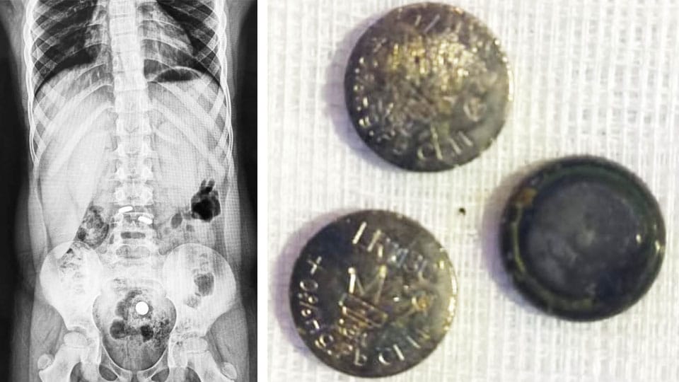 Multiple button batteries removed from a child at Apollo BGS Hospitals
