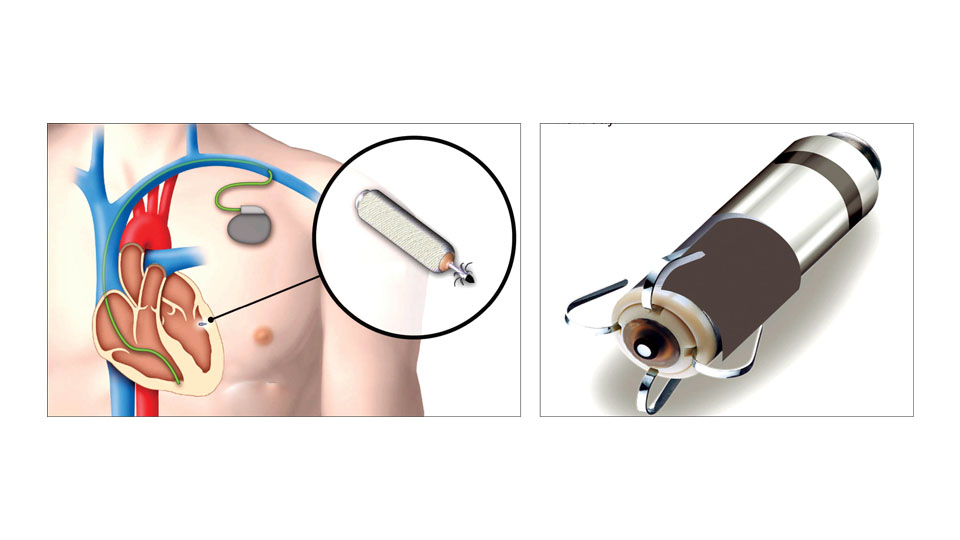 Leadless Pacemaker: A ground-breaking technology used at Narayana Multispeciality Hospital