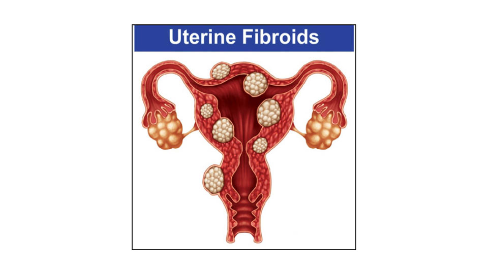 Save Your Uterus