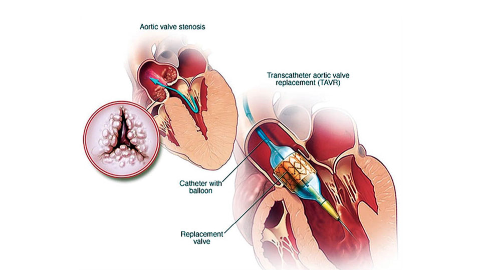 TAVI: A Revolutionary Treatment for Heart Valve Disease