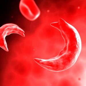 Sickle Cell Disease in Children Challenges and Comprehensive Care