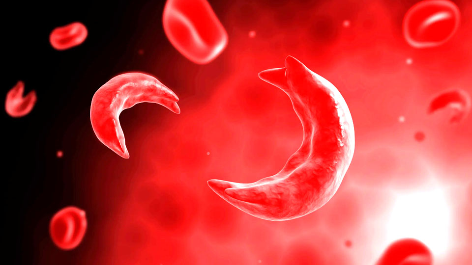 Sickle Cell Disease in Children Challenges and Comprehensive Care