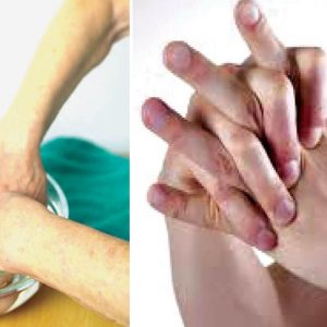 Living with Arthritis