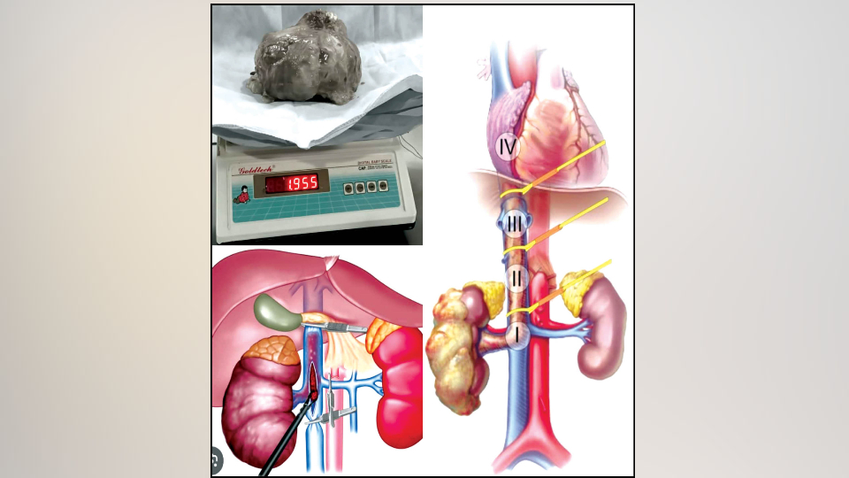 Giant kidney tumour removed in complex surgery at Manipal Hospital